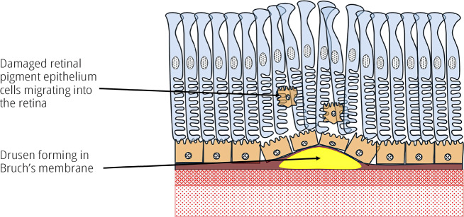 Age-related macular degeneration (AMD): an introduction.