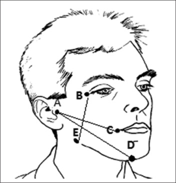 Effects of low-level laser therapy and intramasseteric triamcinolone on postoperative sequelae following mandibular third molar surgery: A comparative study.