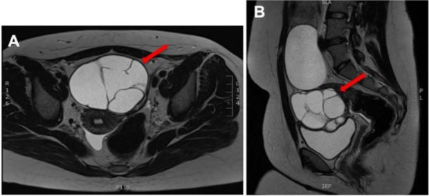 Management of Recurrent Large Bilateral Benign Mucinous Cystadenomas of the Ovary: A Case Report.
