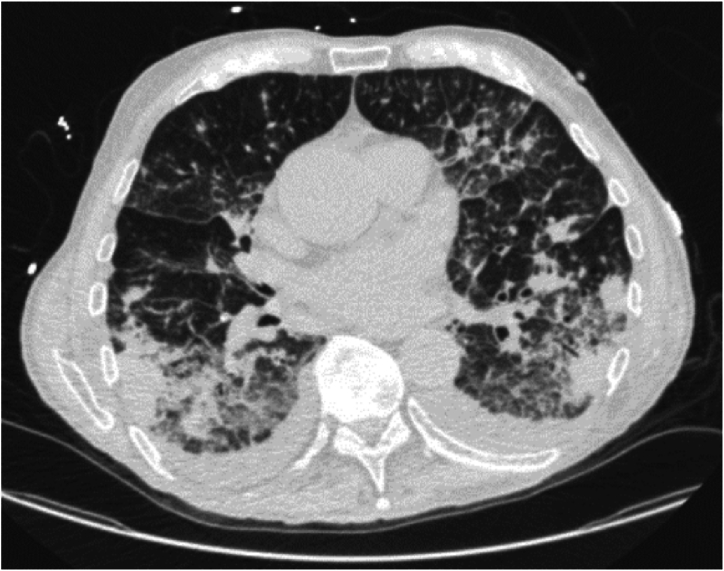 A unique case of extranodal marginal zone lymphoma with synchronous pulmonary and dermatologic manifestations