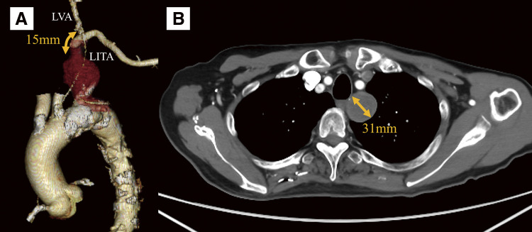 Successful Hybrid Endovascular and Open Approach for Exclusion of a Left Subclavian Artery Aneurysm.