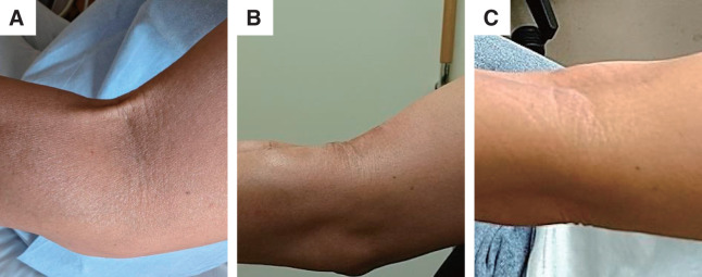 A Case of Elbow Extension Limitation Caused by Phlebosclerosis Following Peripheral Intravenous Chemotherapy: A Case Report and Literature Review.