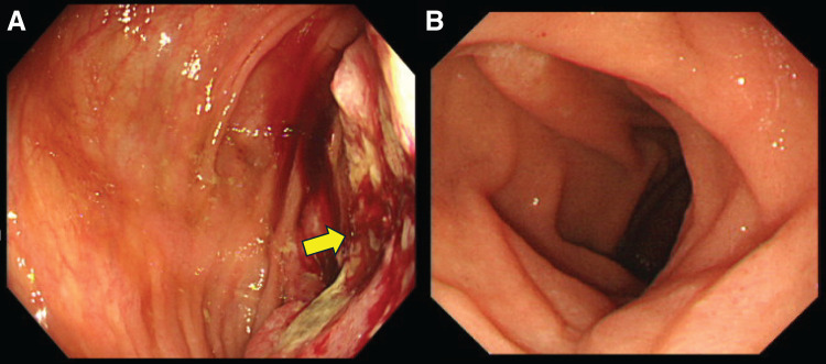 En bloc Right Hemicolectomy with Pancreaticoduodenectomy for Advanced Ascending Colon Cancer.