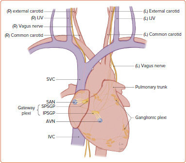 Catheter Ablation for Vasovagal Syncope: The Therapeutic Potential of Gateway Plexi.
