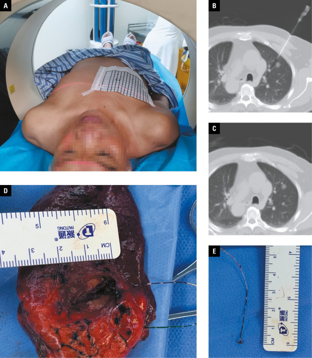 Preoperative localization of pulmonary nodules: virtual bronchoscopic navigation vs a 4‑hook localization needle.