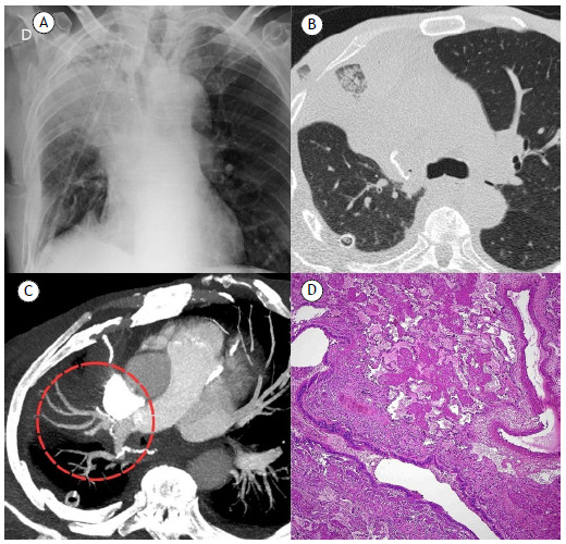 Middle lobe torsion following right upper lobectomy.