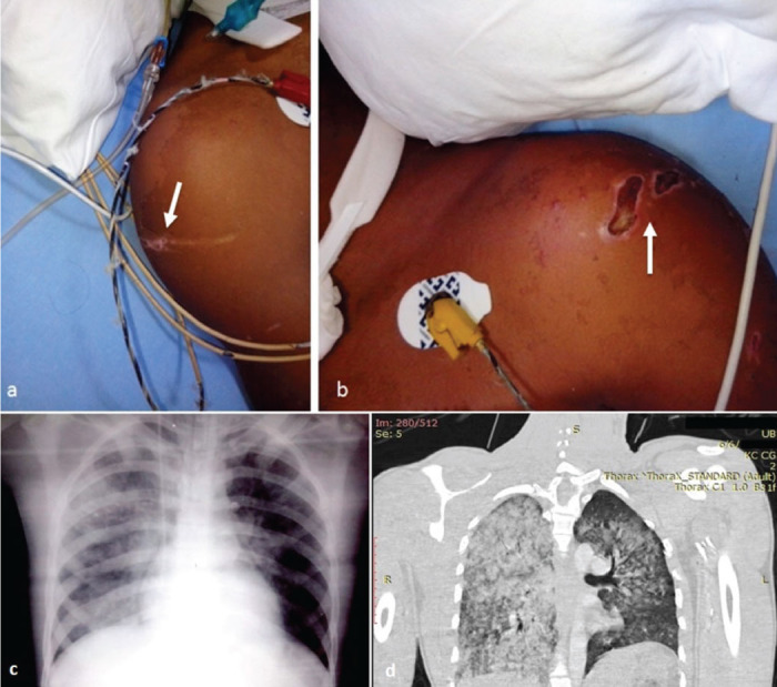 High-Voltage Electrical Lung Injury