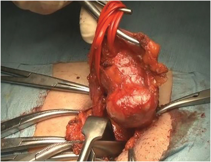 A Case of Myoepithelioma-Like Tumor of the Vulvar Region after Removal of an Inguinal Tumor.