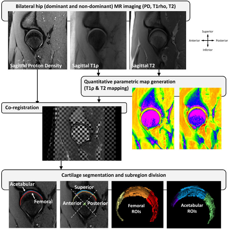 Asymptomatic female softball pitchers have altered hip morphology and cartilage composition.