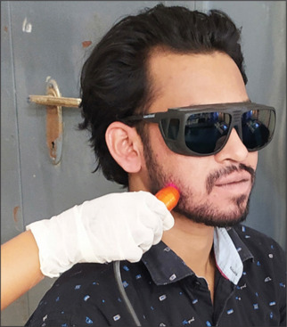 Effects of low-level laser therapy and intramasseteric triamcinolone on postoperative sequelae following mandibular third molar surgery: A comparative study.