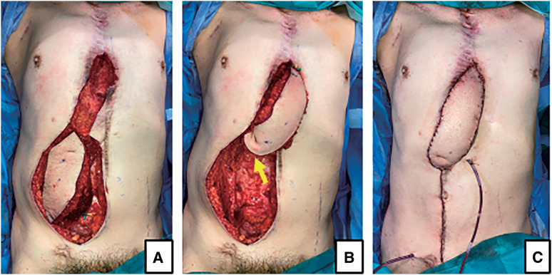 Double-Pedicled Vertical Rectus Abdominis Myocutaneous Flap for Sternal Dehiscence Due to Deep Sternal Wound Infection: The Twelfth Intercostal Artery Perforator as an Additional Pedicle.
