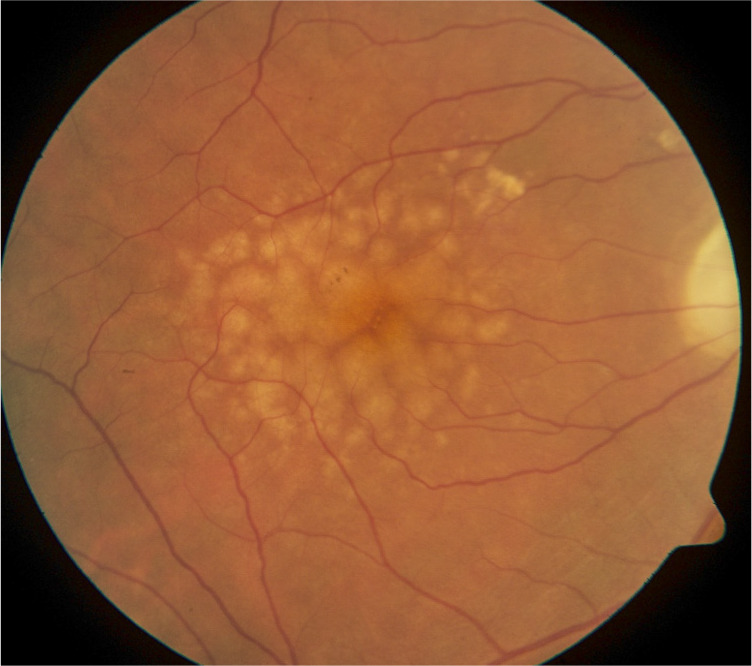 Age-related macular degeneration (AMD): an introduction.