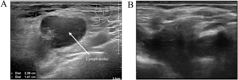A Rare Case of Post-Transplant Lymphoproliferative Disorder Presenting as Hodgkin Lymphoma After Autologous Hematopoietic Stem Cell Transplantation: A Case Report and Literature Review.
