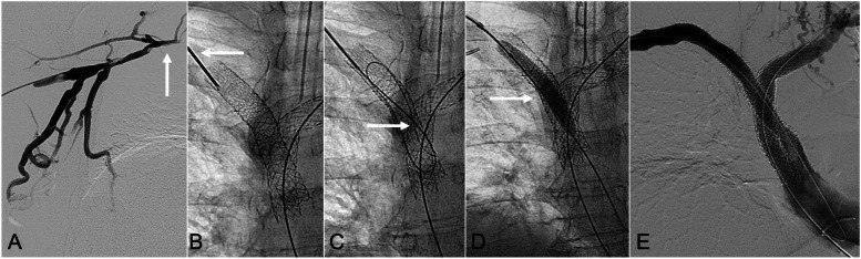 Direct percutaneous puncture of occluded venous stents as an adjunctive technique to restore patency.