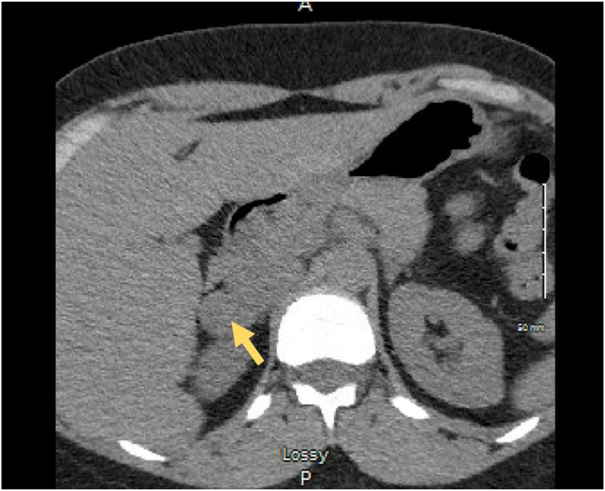 Two Cases of Composite Pheochromocytoma-Ganglioneuromas With Plasma Metanephrine Levels in the Subclinical Range Pheochromocytoma-Ganglioneuroma