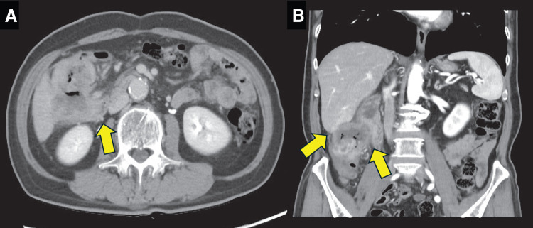 En bloc Right Hemicolectomy with Pancreaticoduodenectomy for Advanced Ascending Colon Cancer.