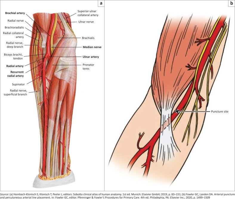 A guide for arterial line insertion for the South African primary care practitioner.