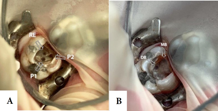 Maxillary Second Molar with Five Root Canals and a Root-Like Enamel Pearl: A Rare Case Report.