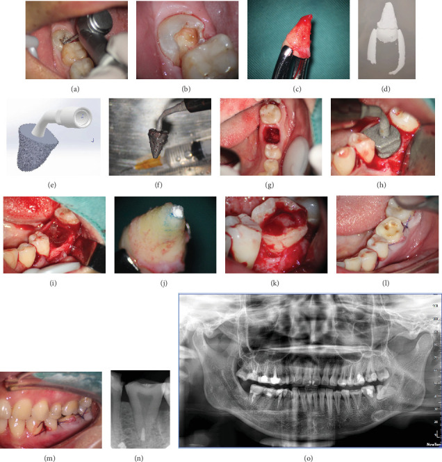 Autotransplantation of a Third Molar to Replace Compromised Molar With the Individual Three-Dimensional Printed Ultrasonic Osteotome: A Case Report.