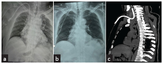 Spontaneous Intravascular Cephalad Migration of Tunneled Cuffed Catheter - An Unusual Late Complication and Role of Re-Imaging.