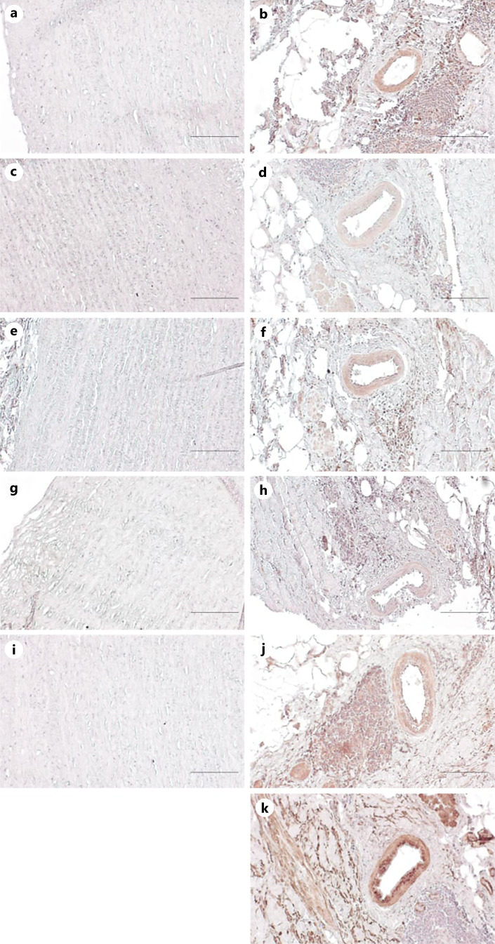 Evaluation of Metabolism-Associated Proteins in Abdominal Aortic Aneurysm.