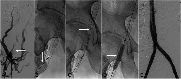 Direct percutaneous puncture of occluded venous stents as an adjunctive technique to restore patency.