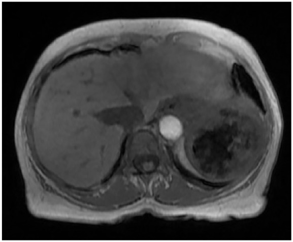 Application of Nuclear Medicine Liver-Spleen Scan for Evaluation of Littoral Cell Angioma of the Spleen: A Case Report.
