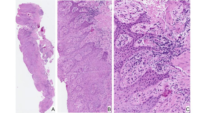 Correction: Oral mucosal changes caused by nicotine pouches: case series.