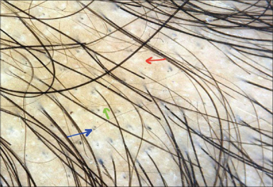 Loose Anagen Hair Syndrome in an Indian Child with Trichoscopic Features.