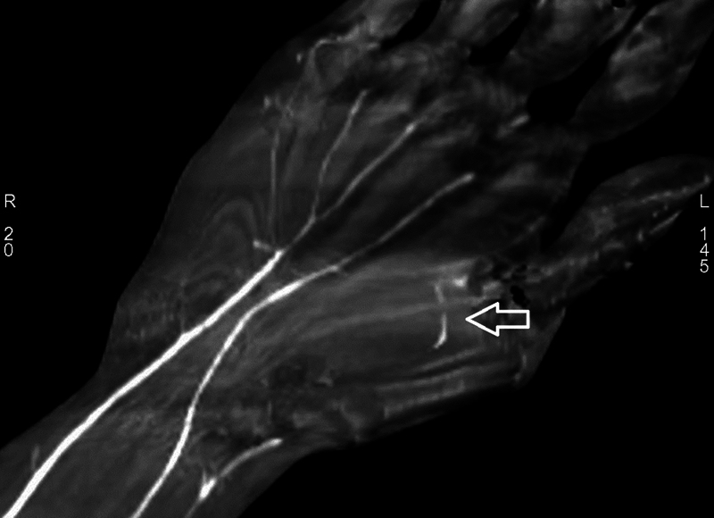 Incidental Finding of an Injured Anomalous Artery in the Forearm: To Repair or Not.