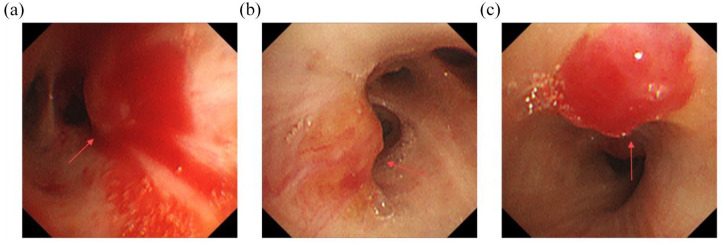 Tracheobronchial amyloidosis with Sjögren's syndrome: a case report.
