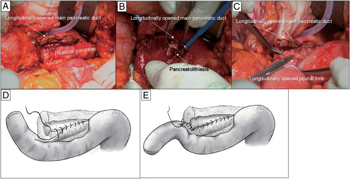 Longitudinal Pancreatojejunostomy for Pancreaticodigestive Reconstruction in the Resection of Pancreatic Head Malignancy with Chronic Pancreatitis: A Case Report.