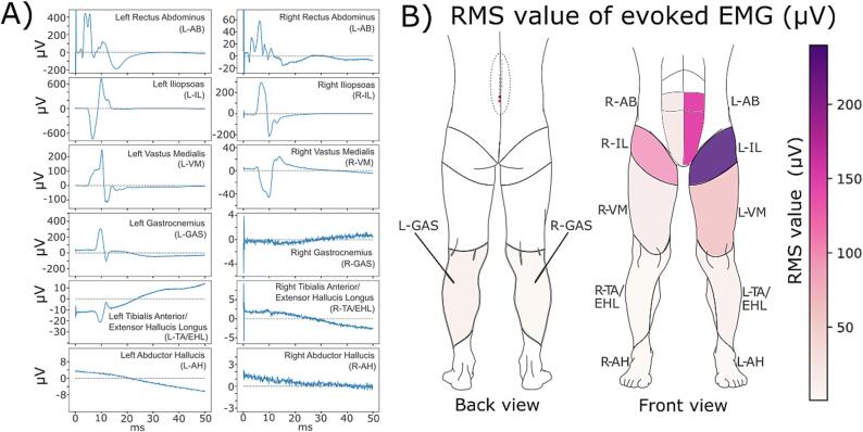 Case report: Potential physiological sources of the late response in epidural spinal recordings induced by spinal cord stimulation during intraoperative neuromonitoring