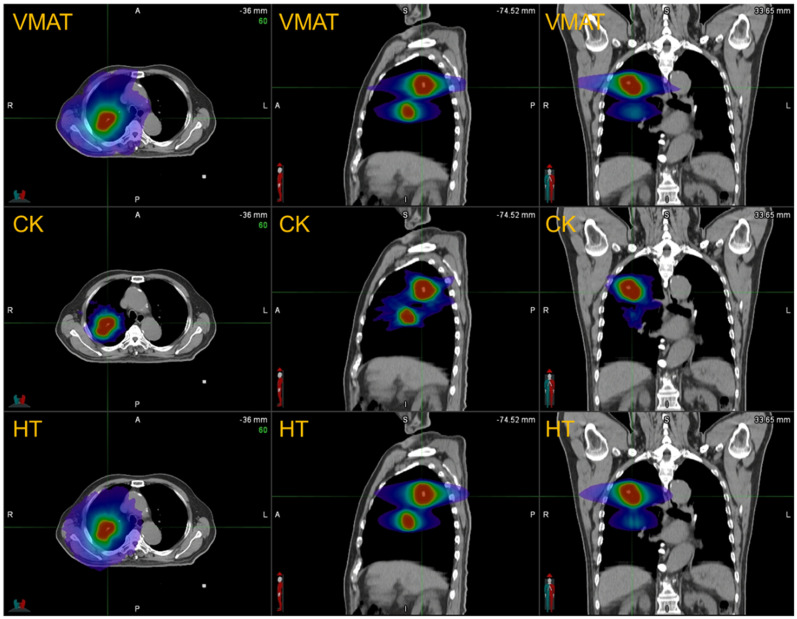 Comparative Dosimetry and Biological Risk Assessment of Lung Oligometastasis SBRT: VMAT, Helical Tomotherapy, and CyberKnife.
