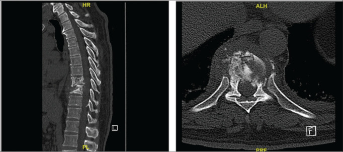 Exploring Thoracolumbar Pott's Disease in the Immunocompetent; Institutional Experience Over a Decade and Comprehensive Literature Review.