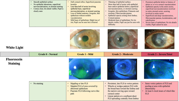 Diagnostic approach to limbal stem cell deficiency.