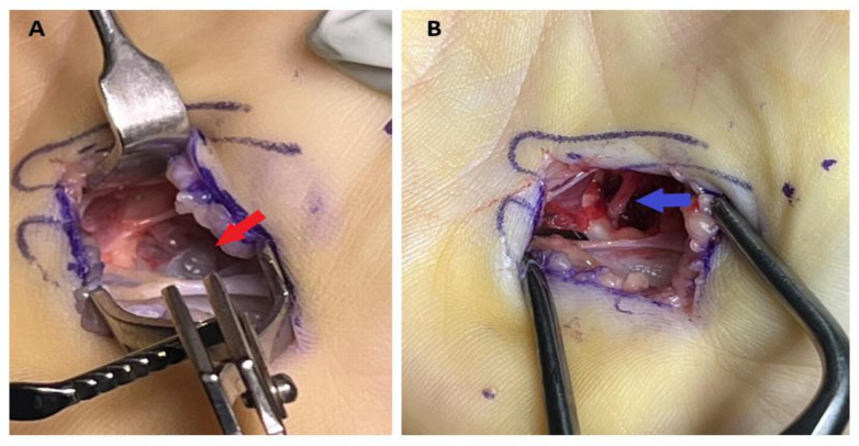 Dorsal Interosseous Muscle Weakness from Mid-palm Ganglion Cyst.