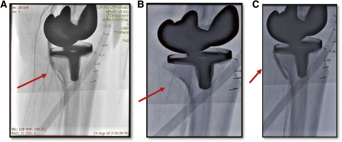 Endovascular Therapy as an Emerging Paradigm for the Treatment of Popliteal Artery Thrombosis Following Total Knee Arthroplasty: A New Approach to Acute Limb Ischemia Management.