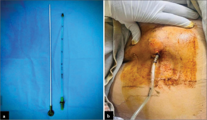Trocar Catheter: A New Alternative for Point of Care for Management of Pleural Effusion by Palliative Care Physicians.