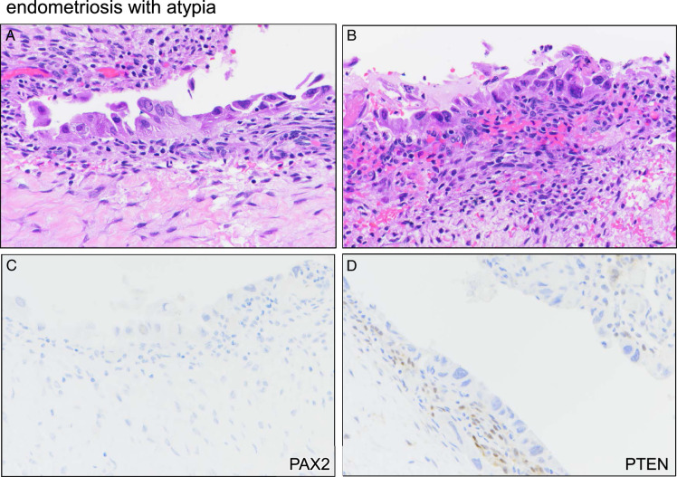 β-catenin, PAX2, and PTEN Aberrancy Across the Spectrum of Endometrioid Ovarian Lesions.