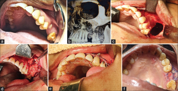 Oroantral Fistula Management in Diabetic Patients - A Case Report.