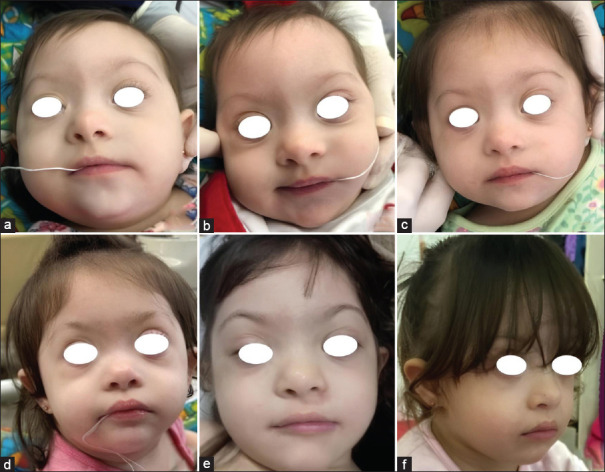 Orofacial Proprioceptive Stimulation Therapy with a Palatal Memory Plate in a Baby with Down Syndrome - 2-year Follow-up Case Report.