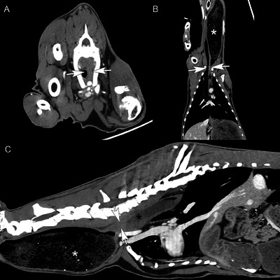 Segmental Megaesophagus Secondary to Extraluminal Esophageal Stenosis Caused by Transitional Seventh Cervical Vertebra and Supernumerary Ribs in a Goat.