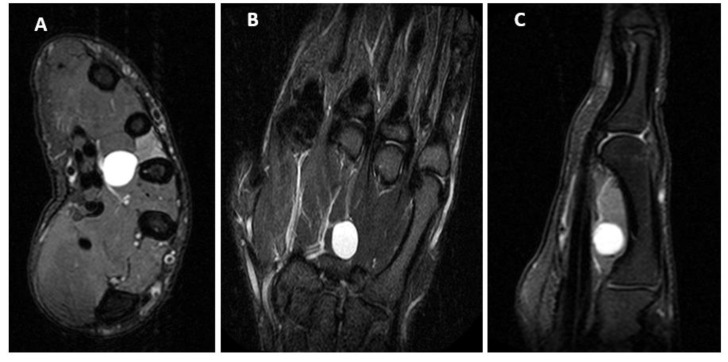 Dorsal Interosseous Muscle Weakness from Mid-palm Ganglion Cyst.