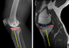 Relationship between the location of the popliteal artery and the tibial osteotomy plane in patients with medial and lateral unicompartmental knee arthroplasty: A retrospective analysis of preoperative magnetic resonance imaging and intraoperative findings.