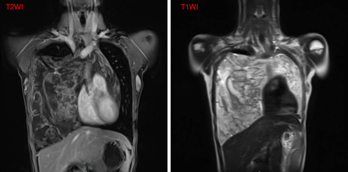 Giant thymolipoma in a 16-year-old girl with multimodal diagnostic approach and surgical management: a case report.