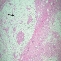 Intraoral Pleomorphic Adenoma of the Minor Salivary Glands: A Case Series of 10 Cases With Emphasis on Histopathological Features.