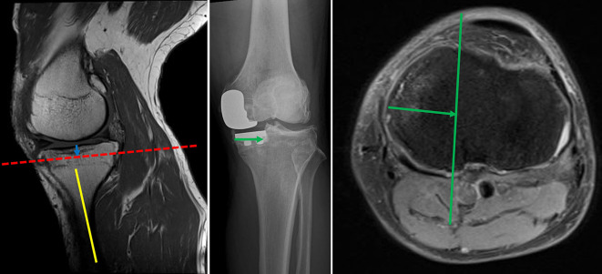 Relationship between the location of the popliteal artery and the tibial osteotomy plane in patients with medial and lateral unicompartmental knee arthroplasty: A retrospective analysis of preoperative magnetic resonance imaging and intraoperative findings.