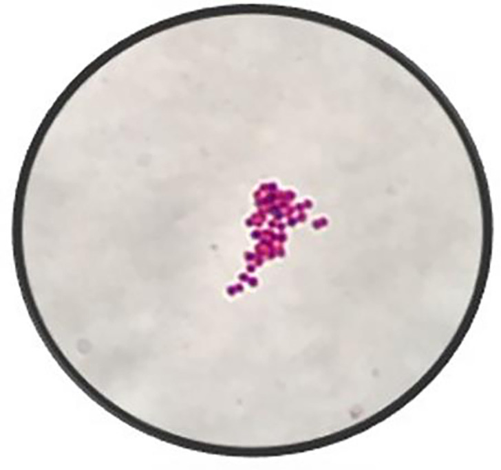 First case report of disseminated gonococcal arthritis in Newfoundland and Labrador.