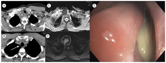 Complicated tracheal diverticulitis.